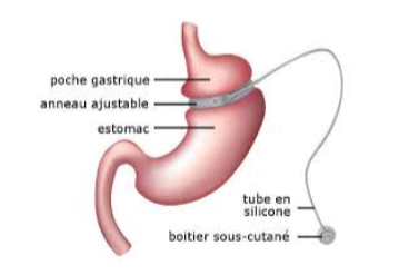 Anneau gastrique virtuel – Cabinet D'hypnose – Philippe BERTET ...